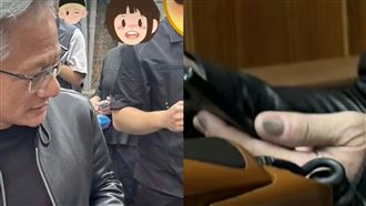 黃仁勳灰指甲引熱議！醫師曝5大可能原因