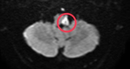 28歲男子到影院看3D電影時，突然左眼不適、嚴重眩暈，經送醫確診腦幹中風。（圖／平等澄清醫院提供）