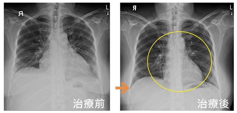 50歲婦不菸不酒,咳嗽胸悶1個月,誤當感冒或更年期,就醫後確診心臟衰竭,心功能僅剩31%。圖左為接受心臟衰竭治療前的X光,心臟擴大與雙側肋膜積水,圖右為接受心衰竭治療後,心臟擴大(黃圈處)與肋膜積水(箭頭處)已改善。(圖/聯新國際醫院提供)