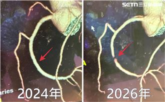 台中男主管胸悶 醫驚：右冠狀動脈1節不見