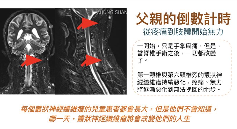 翁德甫指出，叢狀神經纖維瘤並不會隨年齡增長而停止進展，許多成人患者從兒童時期便開始與疾病共存。（圖／翁德甫提供）