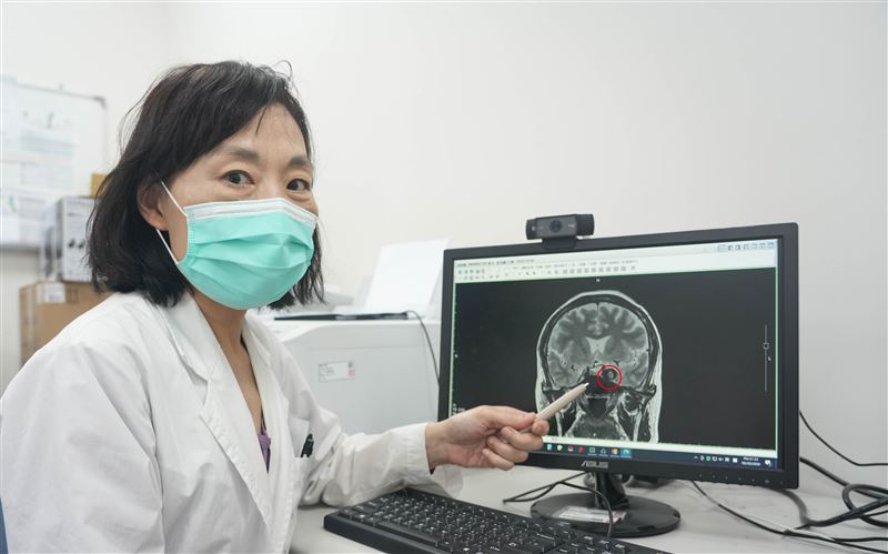 醫療團隊透過導管介入性血管栓塞,置入新型密網支架,有效減緩血流進入腦動脈瘤,加速血栓形成,最後封閉動脈瘤。(圖/光田醫院提供)