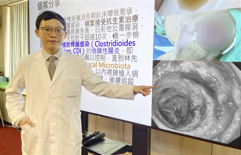 病患因臥床多年,感染困難梭狀桿菌的偽膜性腸炎 ,多線抗生素仍無治癒,最後在腸道植入健康的健康捐贈者的糞便,改善腸道環境。(圖/臺中榮總提供)