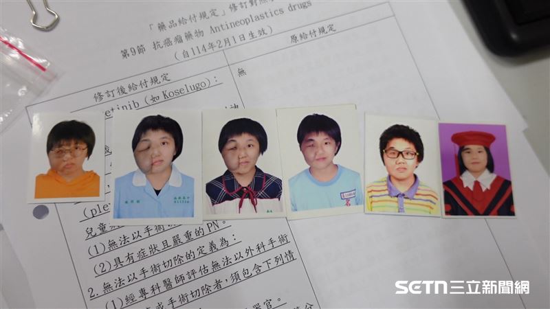 從羽桂幼兒園時期到現在的照片變化可以明顯發現，她的外貌改變並不是一夕之間發生的。大約從國中、高中開始，臉部的腫瘤逐漸變得明顯，不僅範圍越來越大，輪廓也開始受到影響。隨著年齡增長，腫瘤的增生速度似乎變得更加不受控制，讓她不得不一次次接受手術。（圖／記者張雅筑攝）
