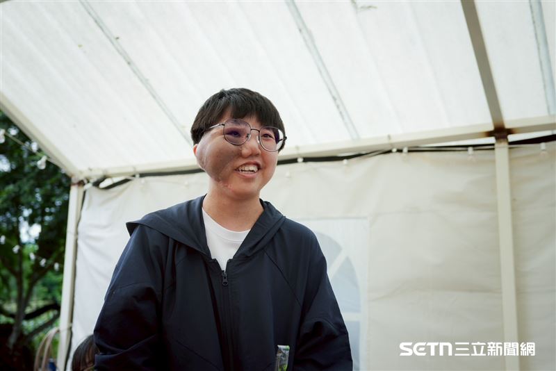 現年21歲的女大生施羽桂，長年飽受「叢狀神經纖維瘤」所苦。那一顆顆反覆增生的腫瘤，不僅改變了她的外貌，也一步步侵蝕著她的生活與身體功能。在長庚顱顏中心主治醫師盧亭辰的介紹下，她掛了林口長庚兒童神經內科主任周怡君醫師的門診，希望能透過口服標靶藥物治療，讓體內不斷增生的腫瘤能夠穩定下來，不再持續惡化，也替自己爭取一個能較正常生活的未來。（圖／羅慧夫顱顏基金會授權提供）