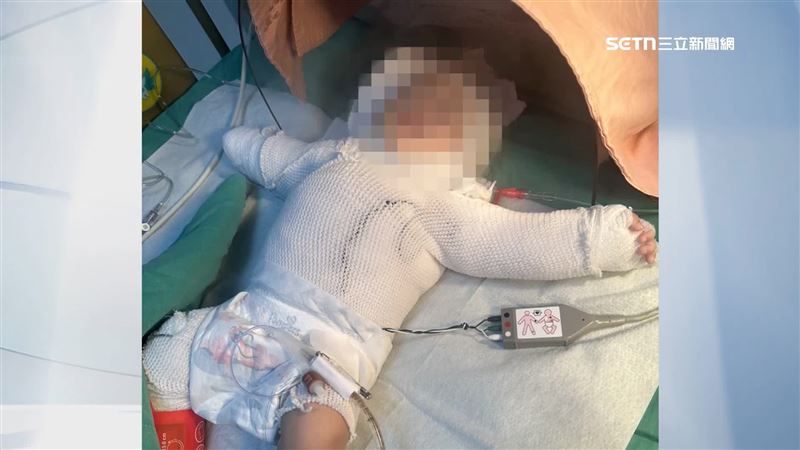 小孩爸爸替一個月大的男嬰洗澡,沒想到寶寶竟搞到三度燒燙傷,目前還在加護病房