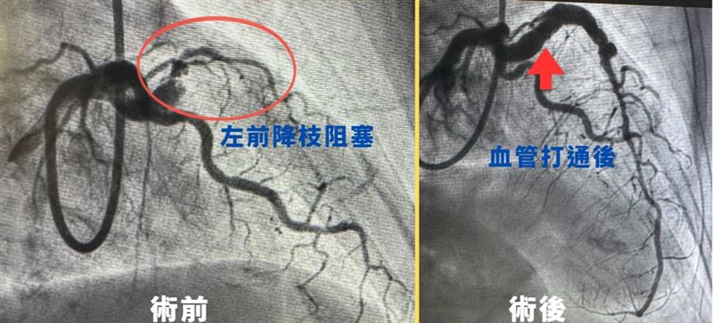 患者被診斷為診斷為急性心肌梗塞，且左前降支動脈已完全阻塞。（圖／中國醫藥大學新竹附設醫院提供）