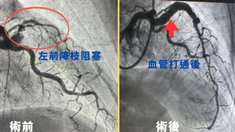 胸悶忍一週心肌梗塞　血管「雙90度轉彎」