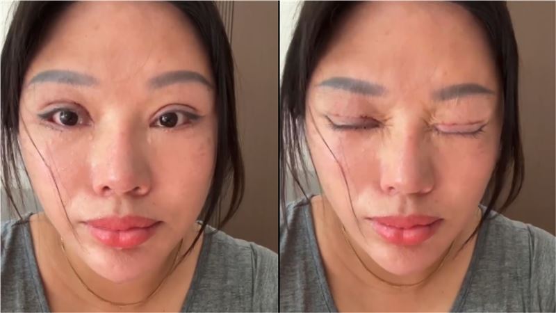 王麗5年前接受雙眼皮手術後，卻出現雙眼無法閉合、淚腺異常等狀況，睡覺時甚至得睜著眼睛入睡。（圖／翻攝封面新聞）