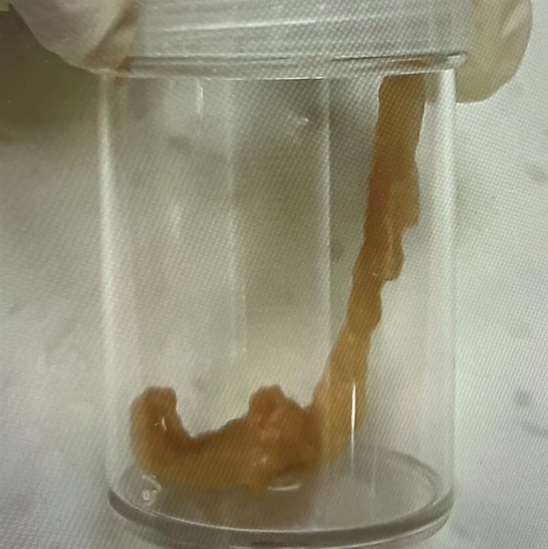 醫師從女童肛門拉出「廣節裂頭絛蟲」，還正在蠕動。（圖／翻攝自Dr. E 小兒急診室日誌粉專）