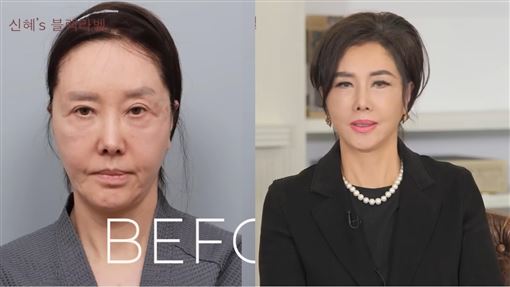 61歲女星臉鬆求醫「拉緊一點」變化太驚人