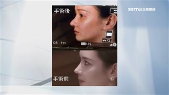 獨／50萬隆鼻變巫婆鼻　女星怒槓台灣鼻王