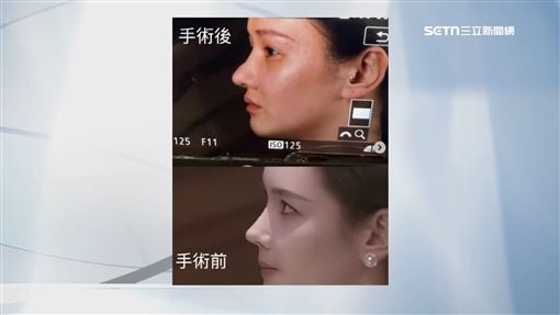 獨／50萬隆鼻變巫婆鼻　女星怒槓台灣鼻王