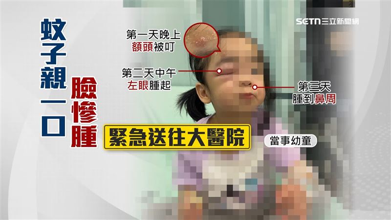 女童本來是只有額頭被叮咬，時隔一天眼睛腫到完全打不開 
