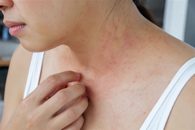 天氣炎熱易冒疹子與搔癢，可能與汗水刺激、汗疹或蕁麻疹有關，應注意保濕與透氣衣物，並改善生活習慣及調整作息。（圖／AI製圖）