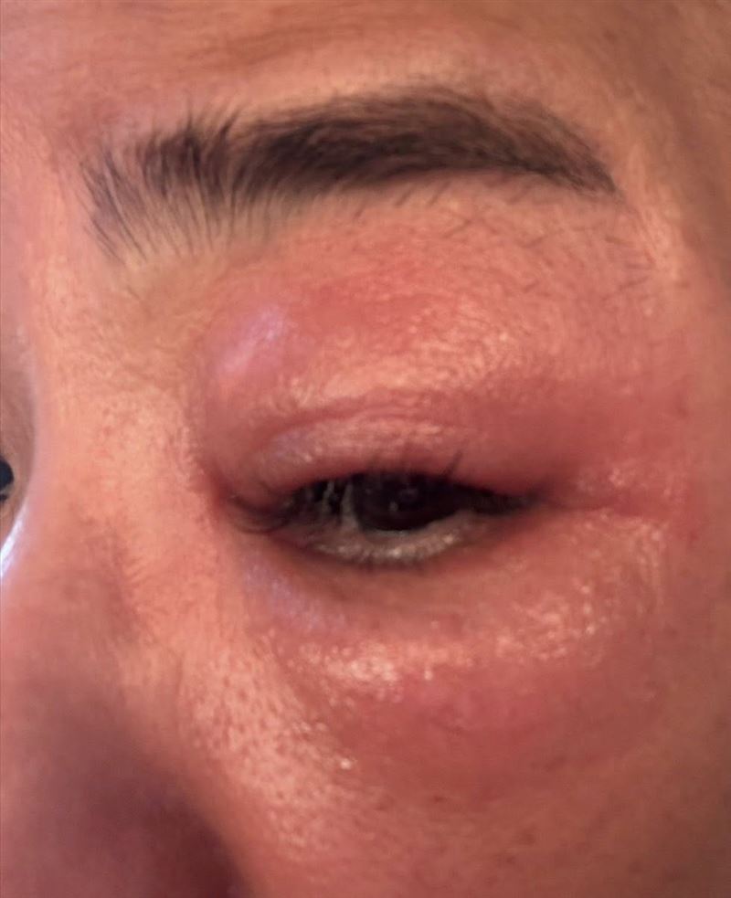 眼睛疑似因接觸隱翅蟲而受到刺激感染,腫脹情況相當明顯。(圖/翻攝自裘海正FB)