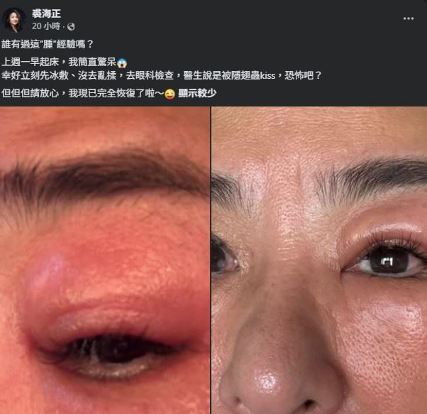 裘海正透露,第一時間先以冰敷方式處理,同時避免用手揉眼,隨後立即前往眼科求診。(圖/翻攝自裘海正FB)