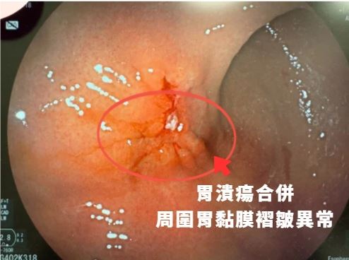患者胃體中段發現一處不到1公分的小型潰瘍,外觀看起來與一般胃潰瘍相似。(圖/中國醫藥大學新竹附設醫院提供)