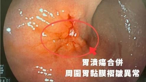 39歲女無症狀竟罹胃癌 醫:4類人快檢查