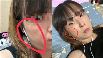 獨／醫美埋線感染！台中女「臉破相」怒告