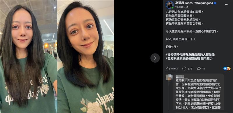 高慧君於近日發文向外界報平安,表示目前右眼狀況仍受先前臉部骨折影響。(圖/翻攝自高慧君FB)