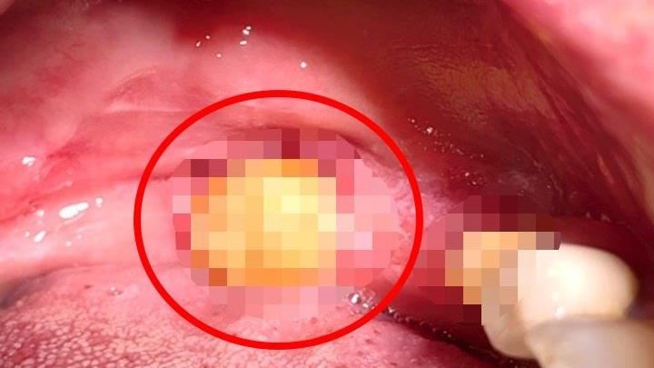 5旬男嘴破變「1顆包」檢查竟變口腔癌