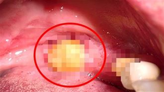 5旬男嘴破變「1顆包」檢查竟變口腔癌