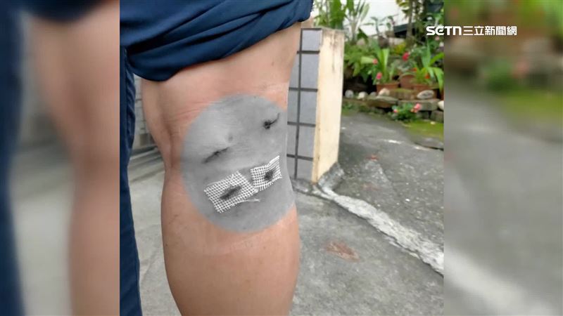 男子小腿四個傷口遭兩隻猴王咬傷