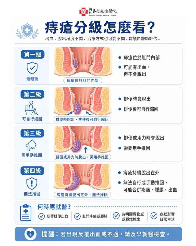 痔瘡分級說明。（圖／新竹馬偕醫院提供）