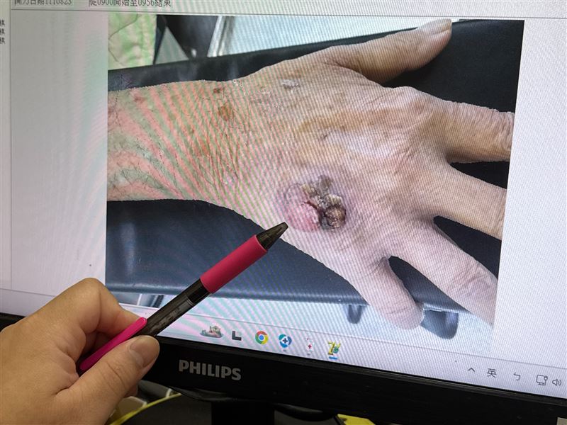 70歲老翁因泌尿感染住院，檢查竟罹患4種癌症，手背上的腫瘤潰爛經檢查竟是皮膚癌。(圖／李綜合醫院提供)