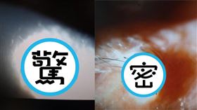 屏東中年男子右眼紅腫睜不開，竟是遭蜘蛛侵入。（洪啟庭醫師提供）