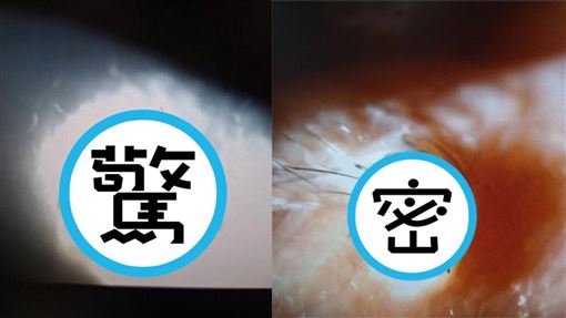 驚悚畫面曝！屏東男午睡遭蜘蛛爬進眼險瞎