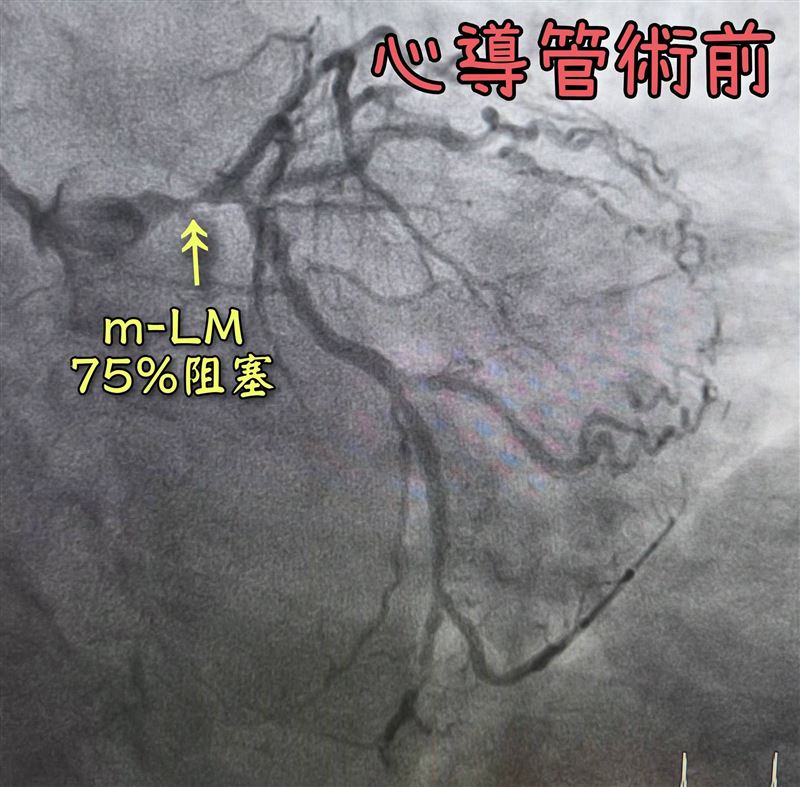 一名67歲患有高血壓、高血脂及糖尿病的男子心肌梗塞2小時。（圖／翻攝自《心臟Worker 曾國翔醫師》臉書）