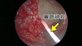 醫師說明，內視鏡經蝶竇找到翼管神經，將之截斷2-3公分，使過敏性鼻炎不容易復發。（圖／台北慈濟醫院提供）