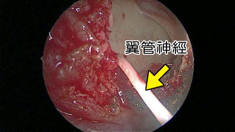 過敏性鼻炎開刀仍復發 醫1手術除心頭大患