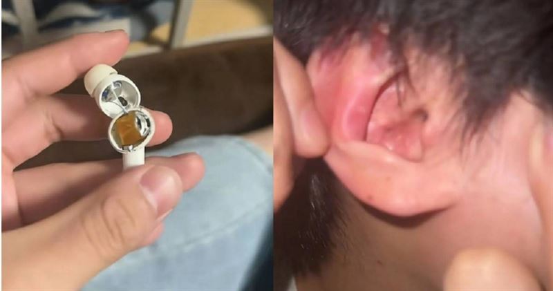 中國河南一名男大學生戴著藍芽耳機看片，耳機突然在耳裡炸裂，所幸就醫後並無大礙。（圖／翻攝自微博）
