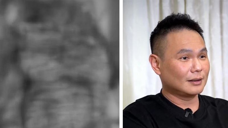 超哥罹癌0期切腸續命!憂人死了錢還沒花完