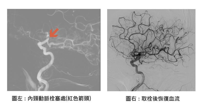 70多歲婦人打麻將時,突右側無力、口齒不清,送醫確診急性缺血性腦中風。(圖/聯新國際醫院提供)(左圖紅色箭頭處為內頸動脈栓塞處,右圖為取栓後恢復血流)