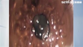 疑戴錯太陽眼鏡　女大生角膜曬傷長滿水泡