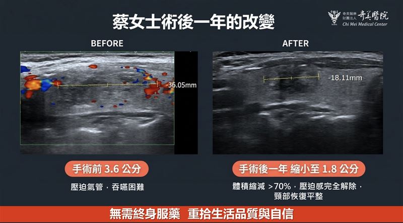 台南女甲狀腺結節「0.5cm→3.6cm」躺平出現窒息感,奇美醫微創消融。(圖/奇美醫院提供)