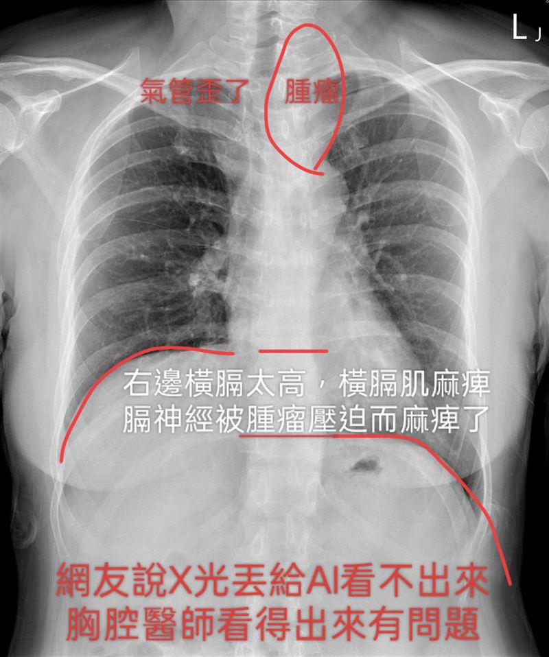 一名女子因稍微咳嗽數月而就診，經X光與胸腔電腦斷層掃描發現，胸腔竟然有6公分大的巨大腫瘤。（圖／蘇一峰提供）