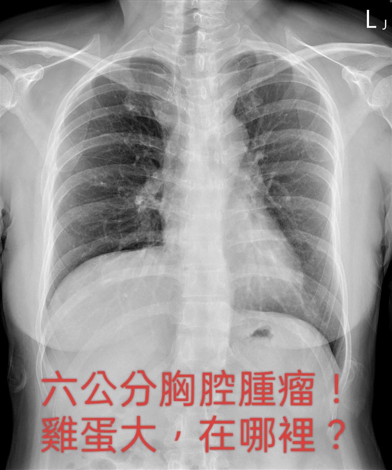 一名50歲女子因稍微咳嗽數月而就診，經X光與胸腔電腦斷層掃描發現，女子竟然有6公分大的巨大胸腔腫瘤。（圖／取自蘇一峰臉書）