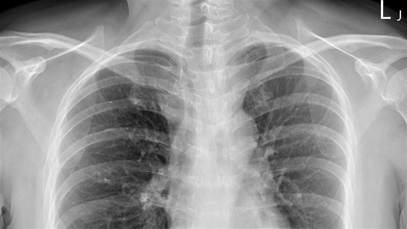 不菸、少煮菜!她竟長「6公分胸腔腫瘤」