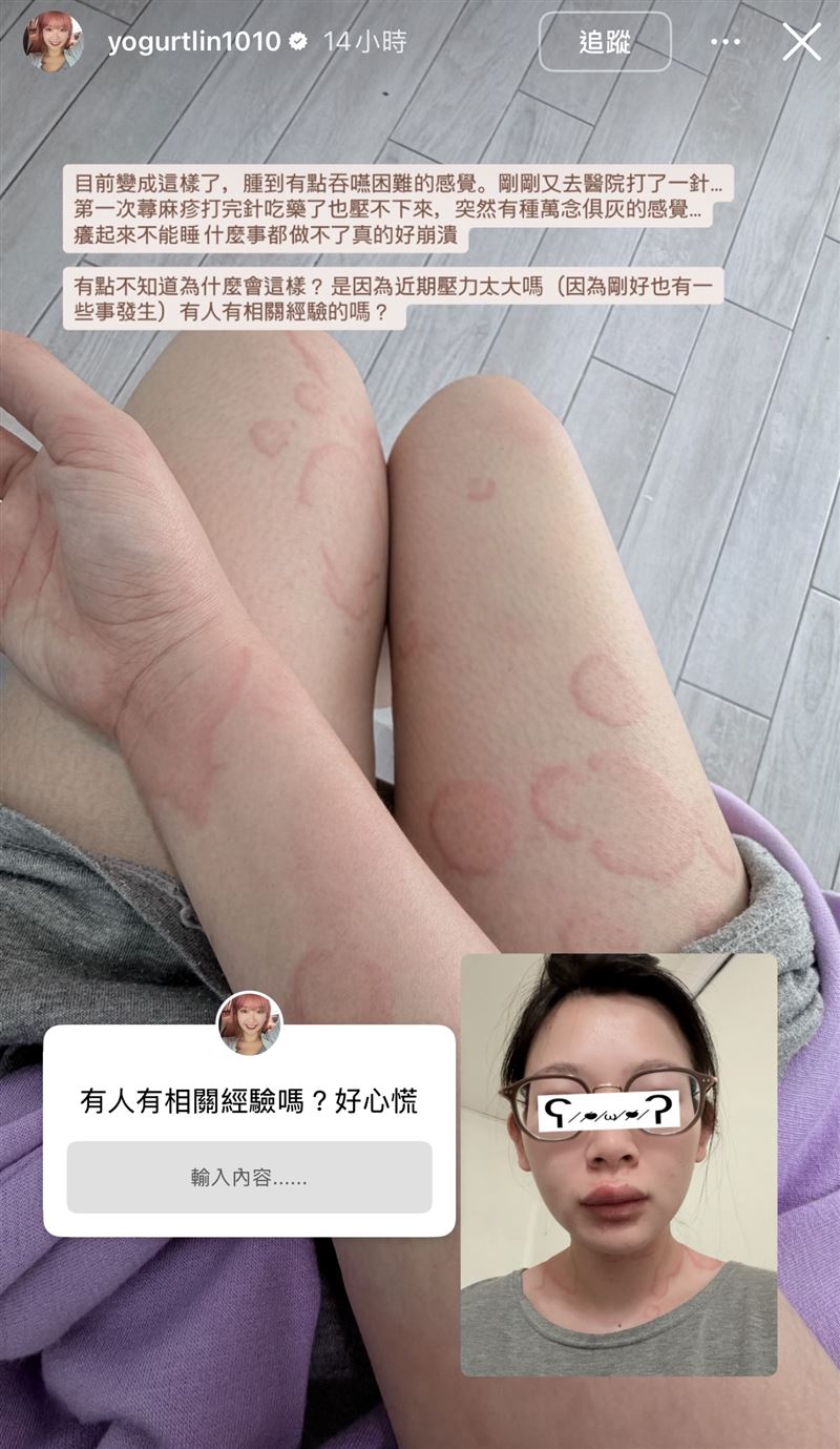 優格姐姐透露蕁麻疹發作。（圖／翻攝自IG）