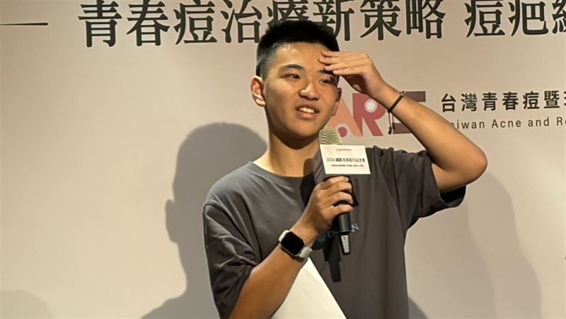 青春痘竟是慢性病 4成人秒停藥落惡性循環