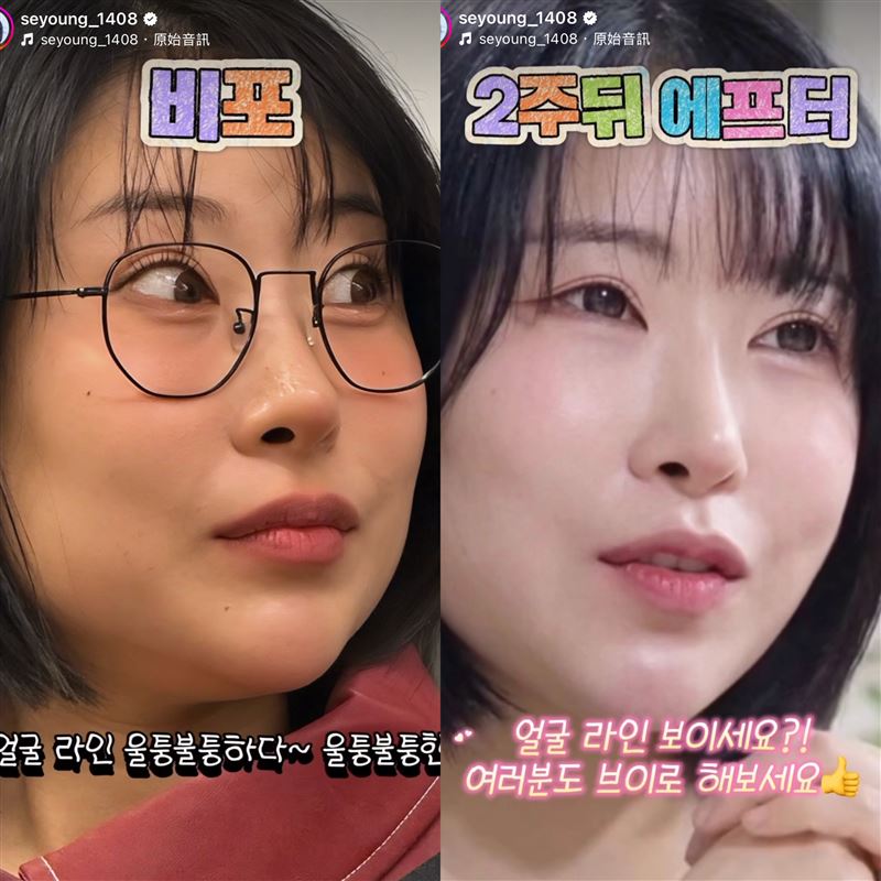 李世英公開接受拉提醫美療程的前後對比照，明顯下顎線條更加緊緻。（圖／翻攝自IG）