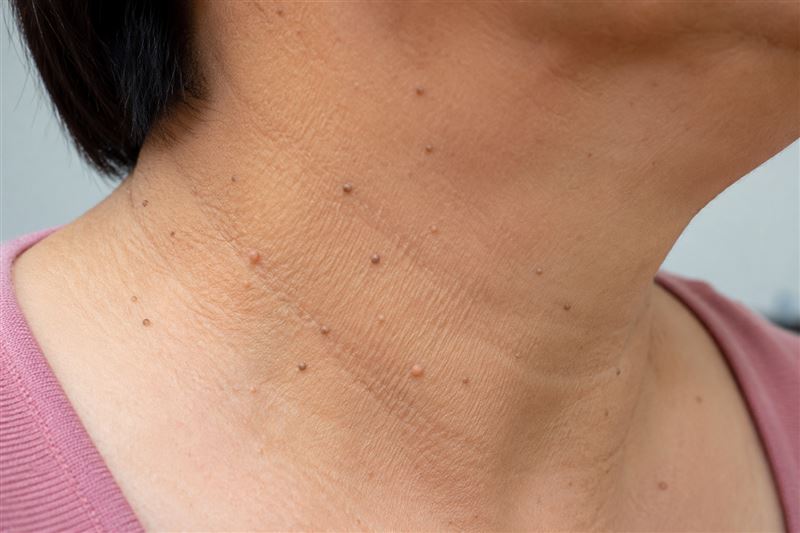 脖子狂冒肉芽 醫揭3異狀別拖：恐藏糖尿病