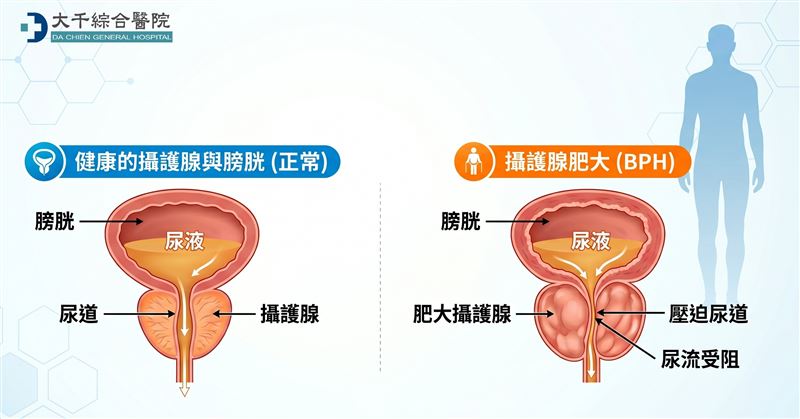 楊立宇醫師強調，攝護腺肥大若置之不理，可能引發尿道感染、腎臟損傷，甚至無法排尿等問題。（圖／大千綜合醫院提供）