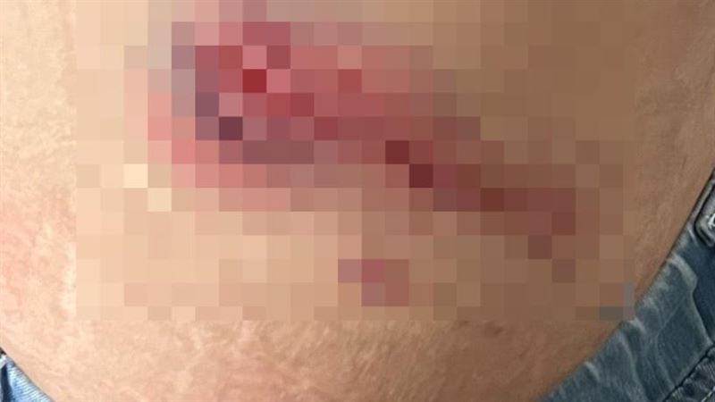 桃園龜山婦人遭獼猴攻擊，腰部被撕咬大塊傷口不斷滲血。（圖／翻攝畫面）