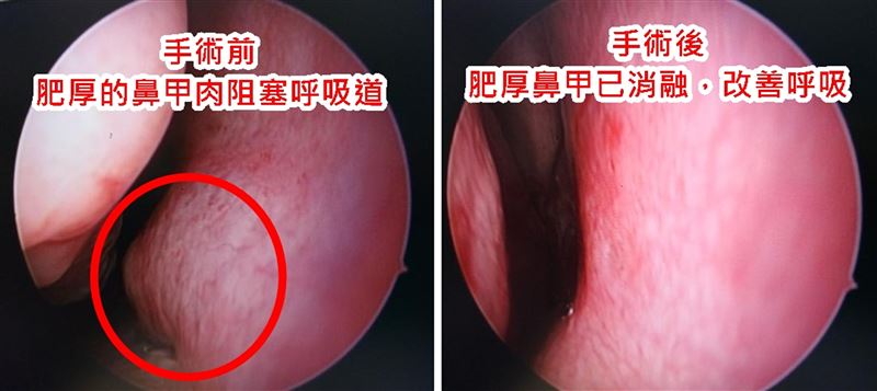 手術前後對比照,肥厚鼻甲已消融。(圖/臺北醫院提供)
